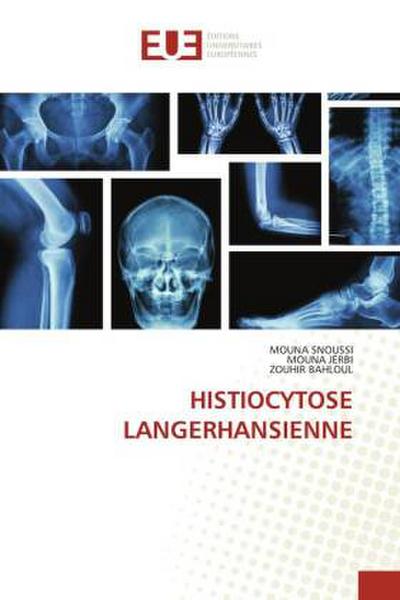 HISTIOCYTOSE LANGERHANSIENNE