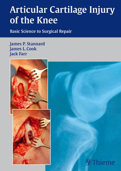 Articular Cartilage Injury of the Knee: Basic Science to Surgical Repair