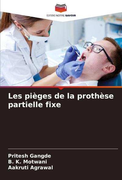 Les pièges de la prothèse partielle fixe
