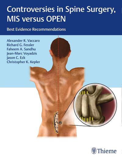 Controversies in Spine Surgery, MIS versus OPEN