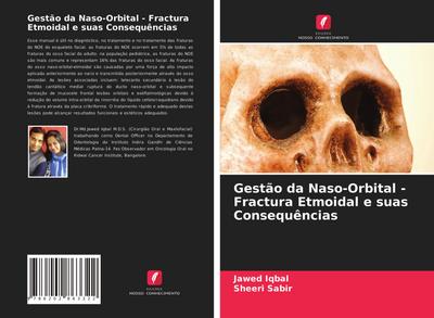 Gestão da Naso-Orbital - Fractura Etmoidal e suas Consequências