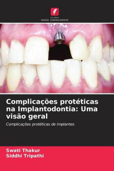Complicações protéticas na Implantodontia: Uma visão geral