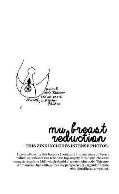 My Breast Reduction