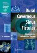 Dural Cavernous Sinus Fistulas by Goetz Benndorf Paperback | Indigo Chapters