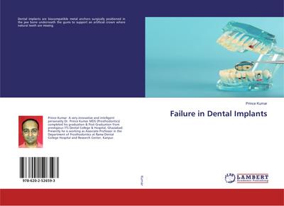Failure in Dental Implants