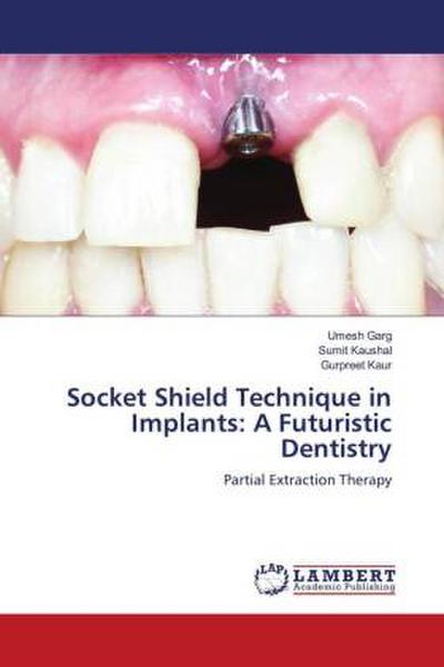 Socket Shield Technique in Implants: A Futuristic Dentistry