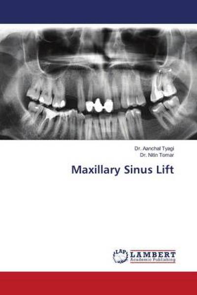 Maxillary Sinus Lift