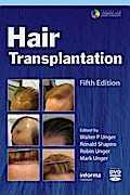 Hair Transplantation