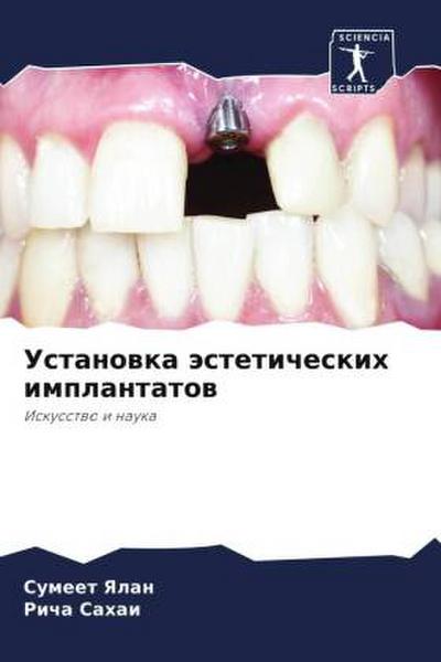 Ustanowka ästeticheskih implantatow