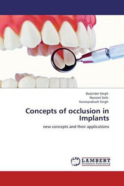 Concepts of occlusion in Implants