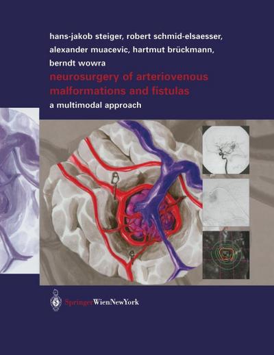 Neurosurgery of Arteriovenous Malformations and Fistulas