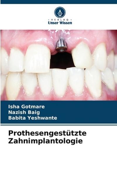 Prothesengestützte Zahnimplantologie