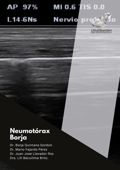 Diagnóstico del neumotórax por ecografía