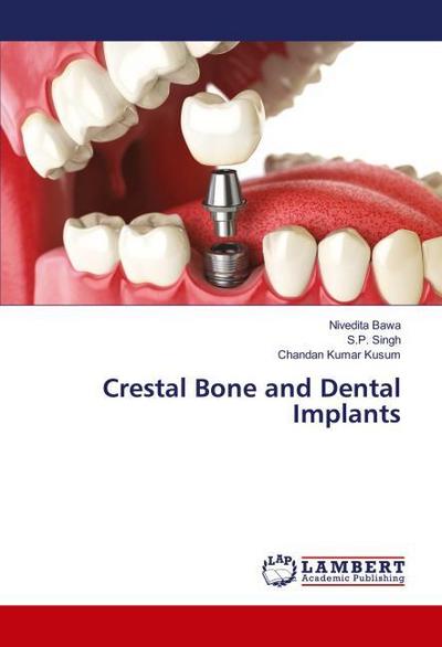 Crestal Bone and Dental Implants