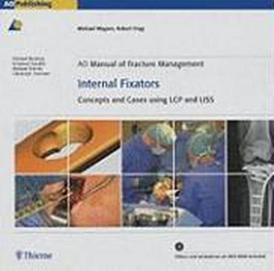 AO Manual of Fracture Management: Internal Fixators: Concepts and Cases Using LCP/LISS [With DVD ROM]