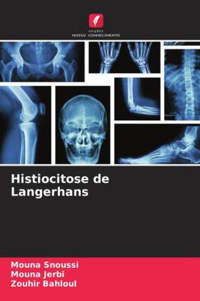 Histiocitose de Langerhans