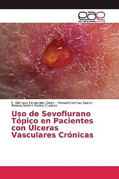 Uso de Sevoflurano Tópico en Pacientes con Úlceras Vasculares Crónicas