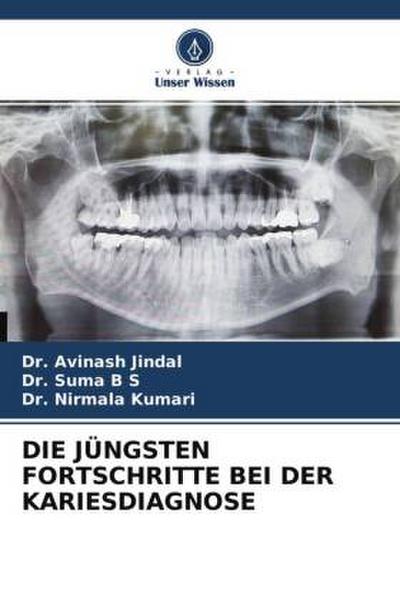 DIE JÜNGSTEN FORTSCHRITTE BEI DER KARIESDIAGNOSE