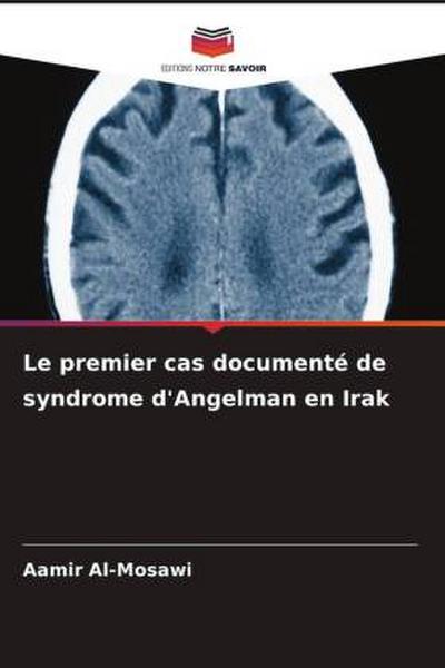 Le premier cas documenté de syndrome d’Angelman en Irak