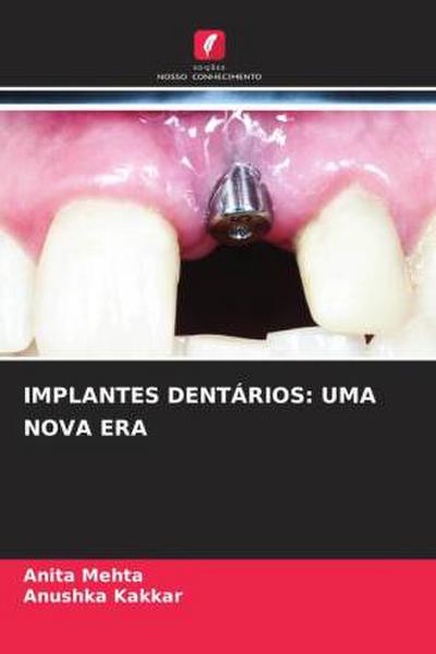 IMPLANTES DENTÁRIOS: UMA NOVA ERA