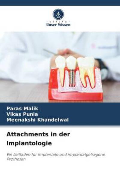 Attachments in der Implantologie