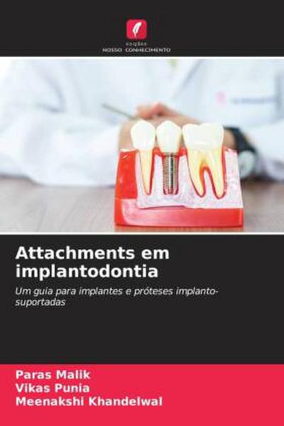 Attachments em implantodontia