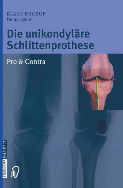 Die unikondyläre Schlittenprothese