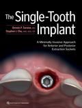 The Single-Tooth Implant: