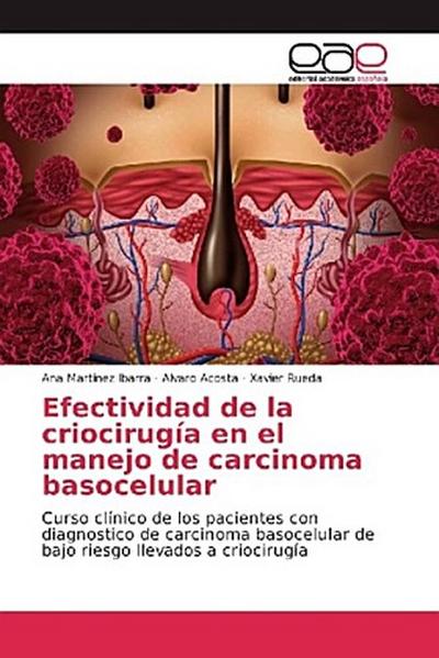 Efectividad de la criocirugía en el manejo de carcinoma basocelular