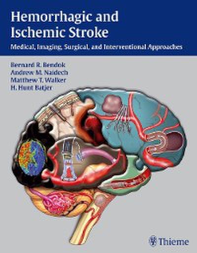 Hemorrhagic and Ischemic Stroke