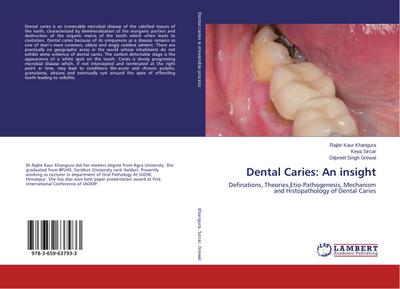 Dental Caries: An insight