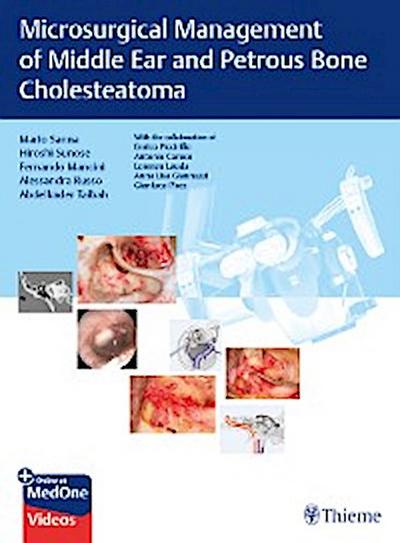 Microsurgical Management of Middle Ear and Petrous Bone Cholesteatoma