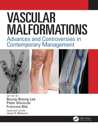 Vascular Malformations