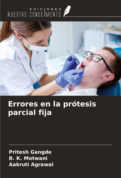 Errores en la prótesis parcial fija