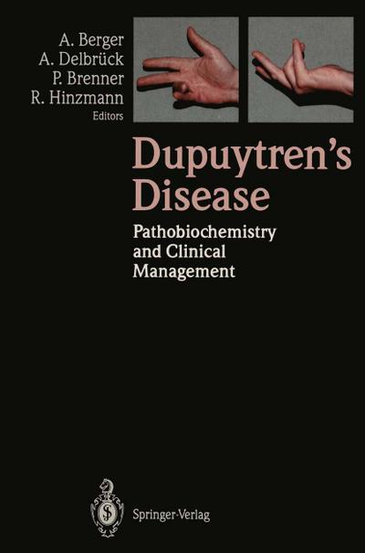 Dupuytrens Disease