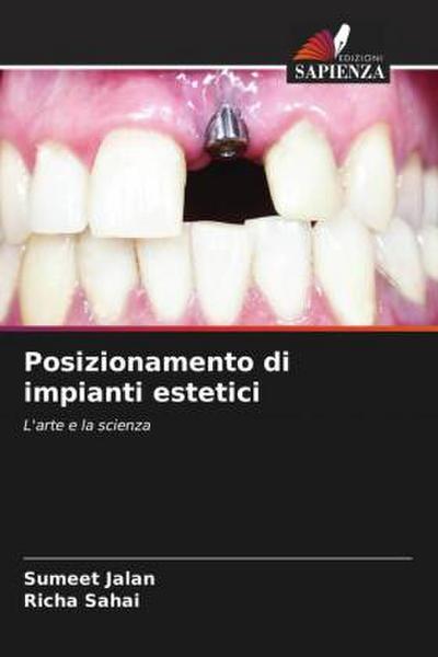 Posizionamento di impianti estetici