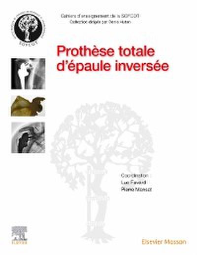 Prothese totale d’epaule inversee