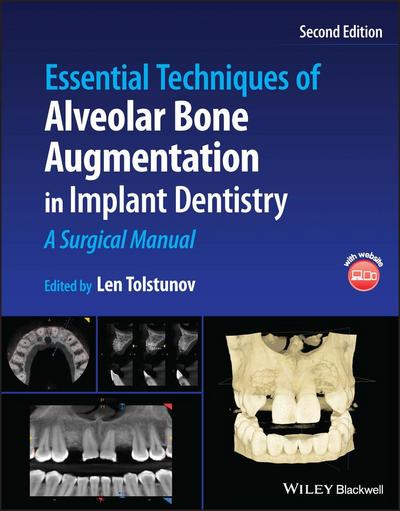 Essential Techniques of Alveolar Bone Augmentation in Implant Dentistry