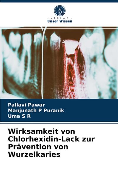Wirksamkeit von Chlorhexidin-Lack zur Prävention von Wurzelkaries