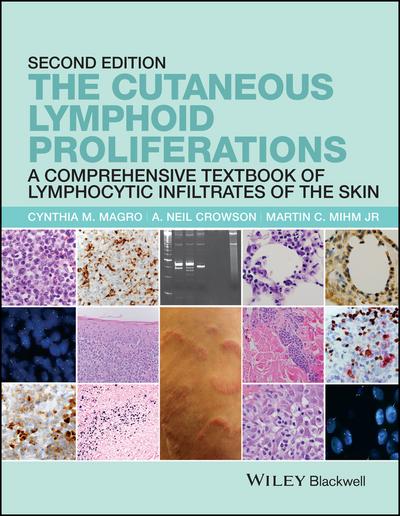 The Cutaneous Lymphoid Proliferations