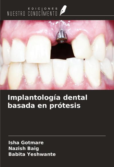 Implantología dental basada en prótesis
