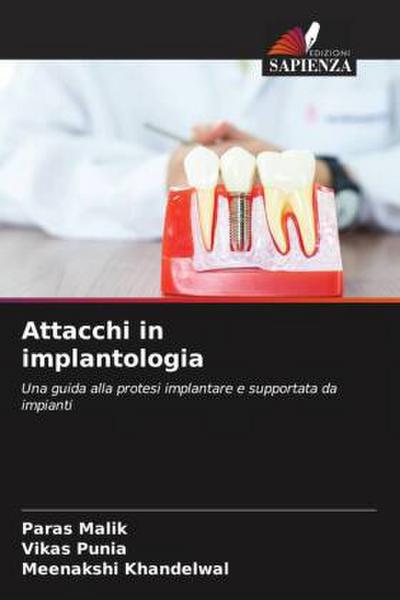 Attacchi in implantologia