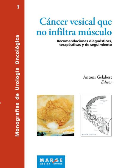 Cáncer vesical que no infiltra músculo