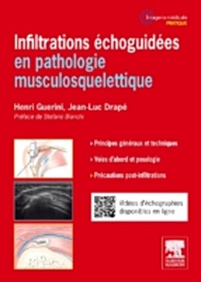 Infiltrations echoguidees