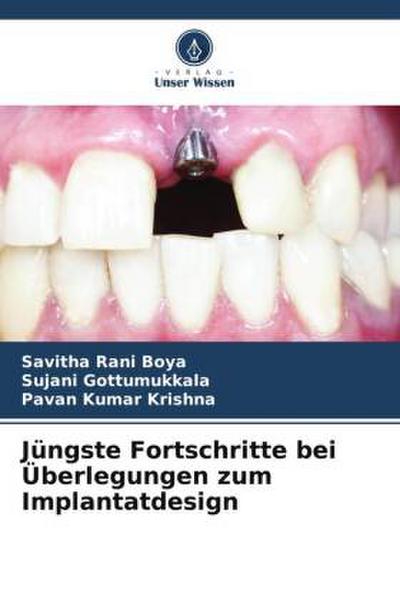 Jüngste Fortschritte bei Überlegungen zum Implantatdesign