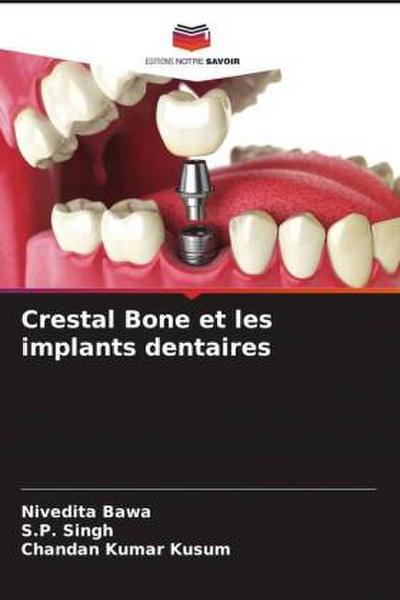 Crestal Bone et les implants dentaires