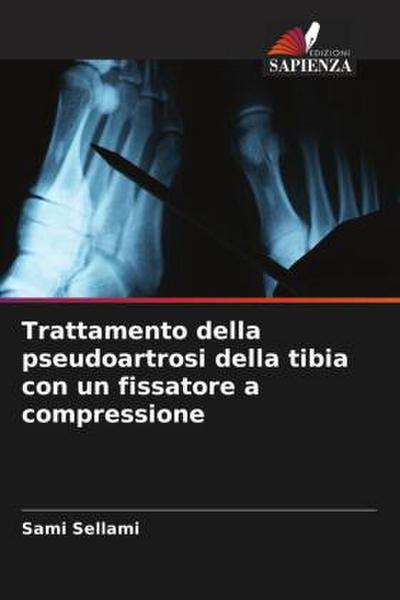 Trattamento della pseudoartrosi della tibia con un fissatore a compressione