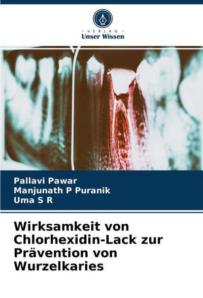 Wirksamkeit von Chlorhexidin-Lack zur Prävention von Wurzelkaries