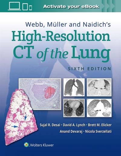 Webb, Muller and Naidich’s High Resolution of Lung CT