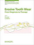 Erosive Tooth Wear